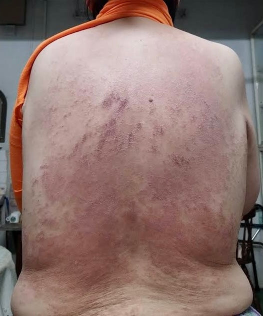 Decoding Psoriasis vs Eczema vs Dermatitis