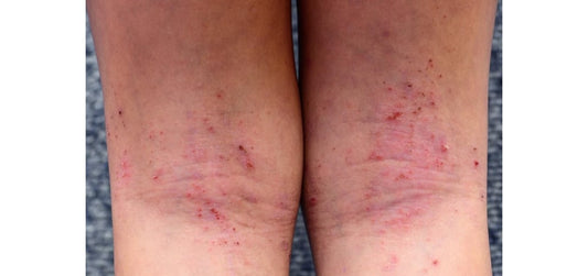 Rash or Eczema: Understanding the Key Differences